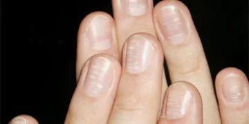 Почему появляются белые пятна на ногтях? Ответил врач